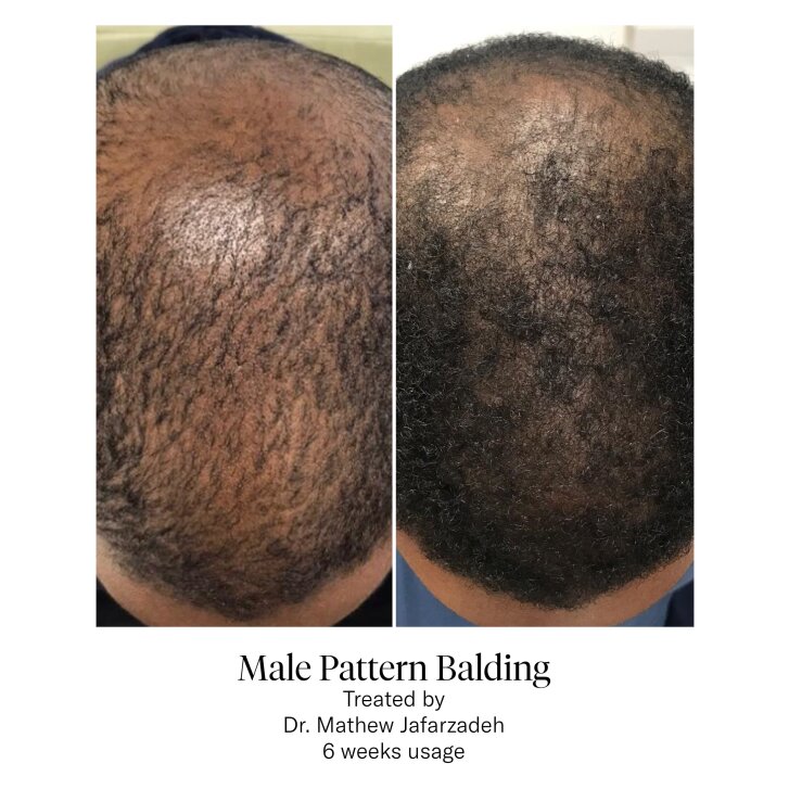 CALECIM Professional Advanced Hair Ampulle 1x5ml